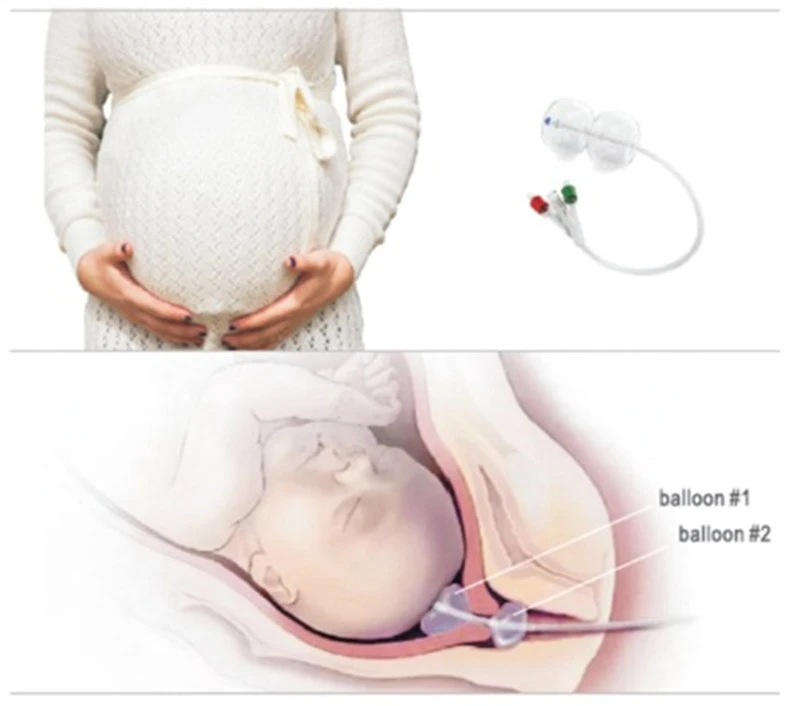 Cervical Ripening Balloon manufacturers